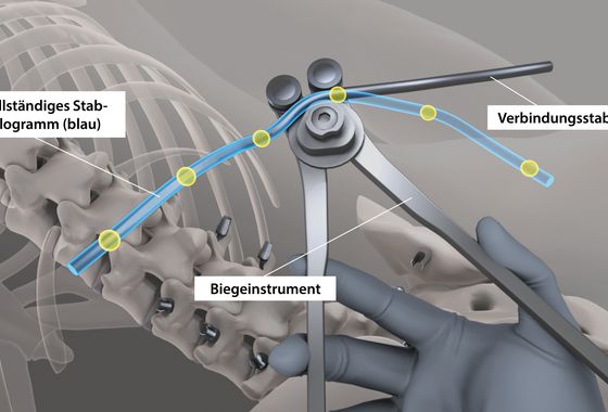 Wenn das Stabimplantat auf die Positionen der Pedikelschrauben angepasst ist, wird es eingesetzt und an den Pedikelschraubenköpfen fixiert.