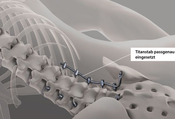 Wenn das Stabimplantat auf die Positionen der Pedikelschrauben angepasst ist, wird es eingesetzt und an den Pedikelschraubenköpfen fixiert.