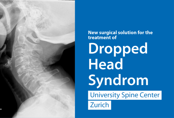 Surgery «Dropped Head Syndrom» Radiograph of the neck of a patient with Dropped head syndrome.