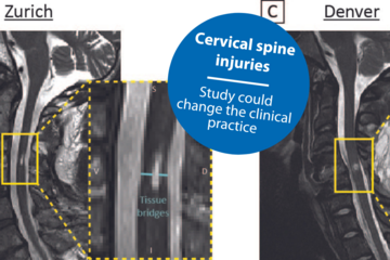 Prognostic value of tissue bridges in cervical spinal cord injury Tissue bridges in cervical spinal cord injury
