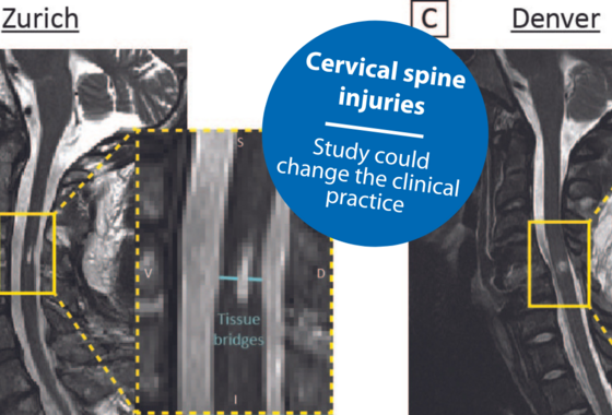 Prognostic value of tissue bridges in cervical spinal cord injury Tissue bridges in cervical spinal cord injury