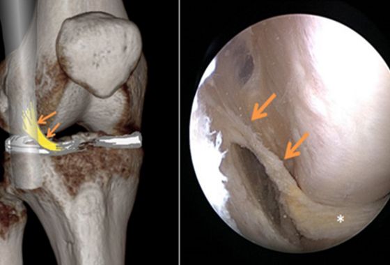 Das AIML ist laut der soeben veröffentlichten Studie eine anatomische Variante der Aufhängung des Aussenmeniskus  Das AIML ist laut der soeben veröffentlichten Studie eine anatomische Variante der Aufhängung des Aussenmeniskus