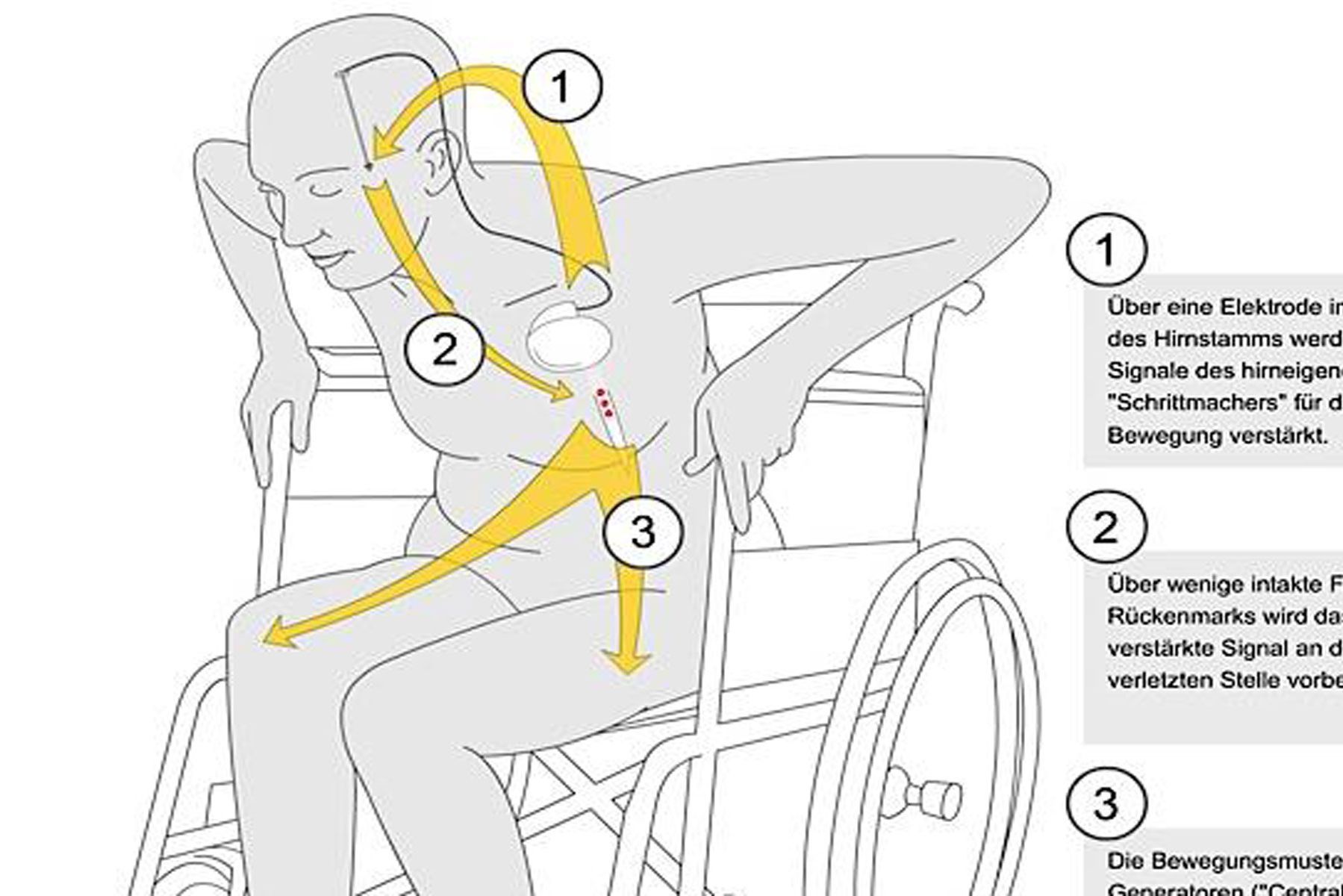 Deep Brain Stimulation Balgrist Research Paraplegia