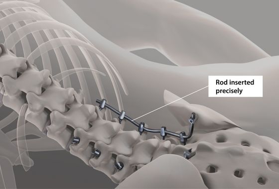 As soon as the rod implant is tailored to the positions of the pedicle screws, the implant is affixed to the screws.