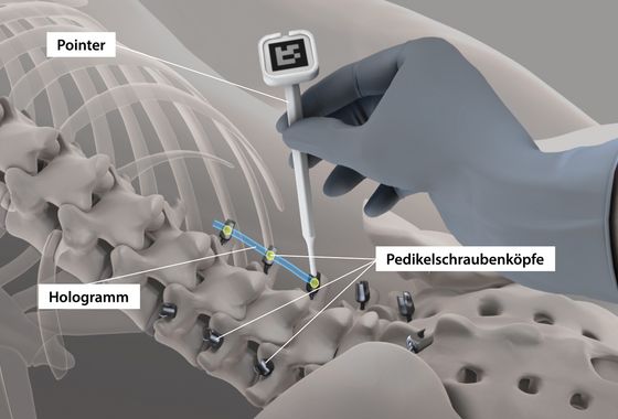 Nach dem Einsetzen der Pedikelschrauben in die Wirbel werden die Positionen der Schraubenköpfe mit einem Pointer präzise erfasst.