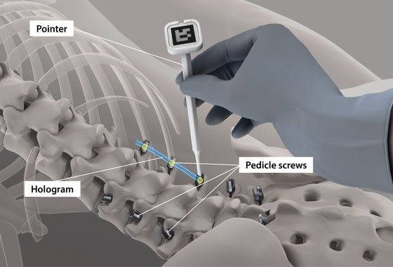 After placing pedicle screws into the vertebrae, the operator equipped with a mixed-reality headset starts to precisely register the positions of the screws with a pointer.