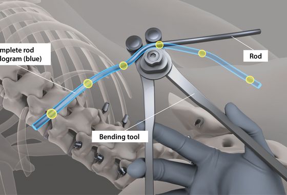 Once all positions have been recorded, a virtual template for the rod implant is displayed.