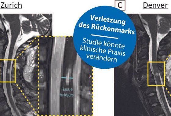 Gewebebrücken sind zuverlässige Prädiktoren zur  Genesung bei Halswirbelsäulenverletzungen Bildgebung Gewebebrücken