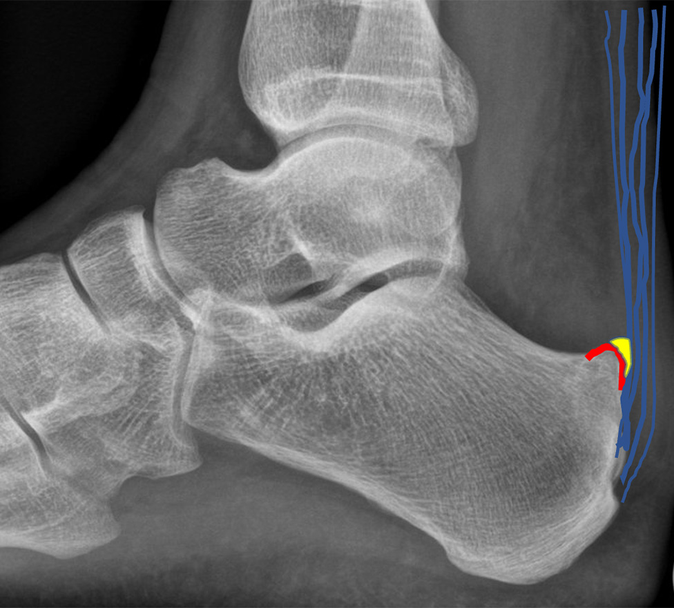 Im Röntgenbild einer wird die Haglund-Deformität rot angezeigt. Der Schleimbeutel zwischen Sehne und Knochen ist gelb markiert und die Achillessehne mit blauen Linien symbolisiert.