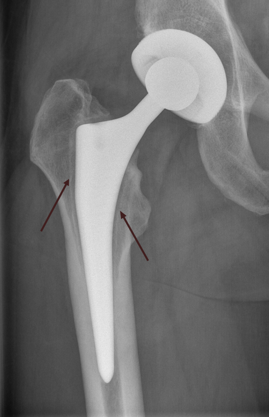Röntgenaufnahme eines künstlichen Hüftgelenks mit Lockerungssaum, dargestellt als dünne weisse Schicht.