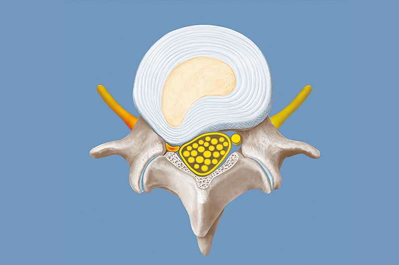 Bandscheibenvorfall mit Kompression des Nervs