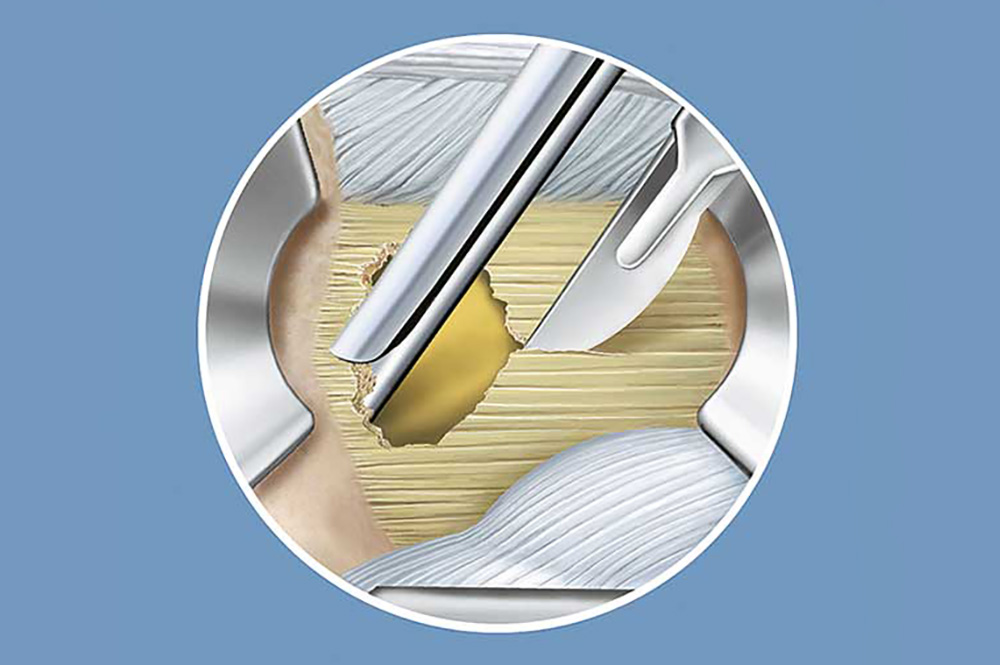 Freilegung des Spinalkanals, Sicht auf darunterliegenden Nerv.