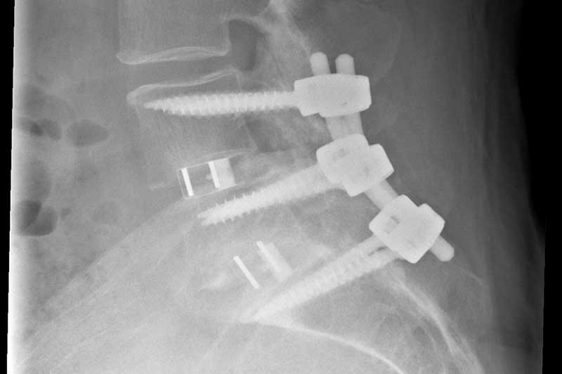 Stabiisation der Wirbelsäule