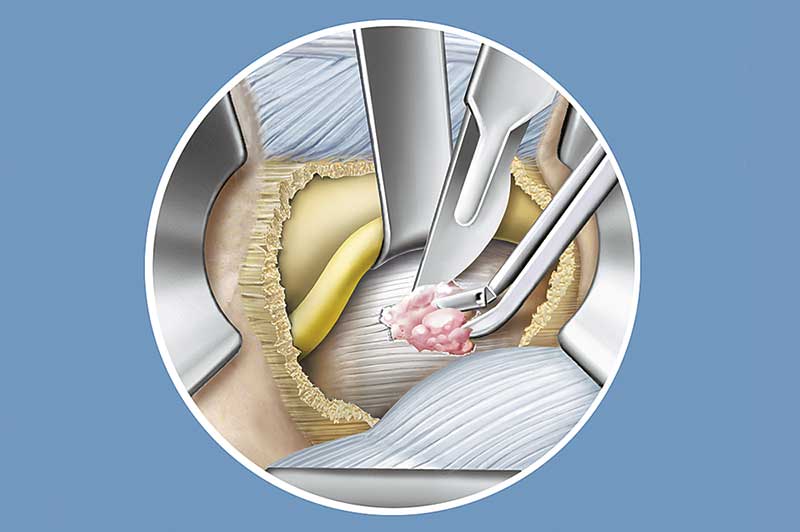 Retraktion der Nervenwurzel (gelb) und Entfernung des Bandscheibenvorfalls (rot).