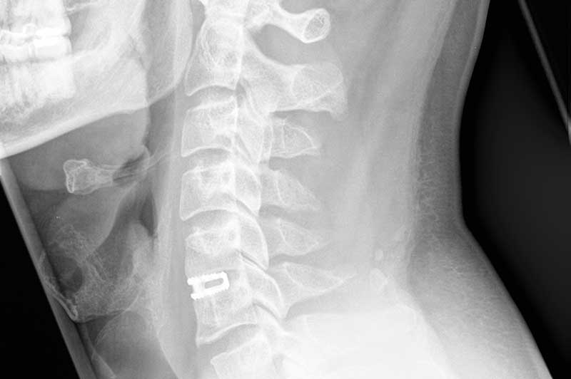 Seitliches Röntgenbild nach einer Dekompression und Fusion der Halswirbelsäule mit einem Cage (Abstandhalter) im Segment C5/C6.