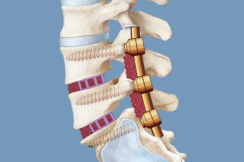 Zusätzliche Stabilisation der Wirbelsäule durch Implantation von Cages