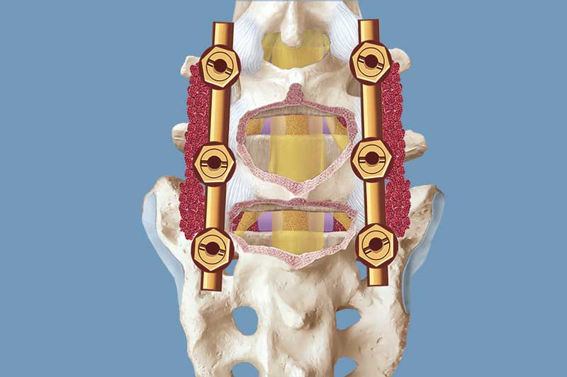 Stabilisation der Wirbelsäule mit Titanschrauben und Knochenanlagerungen