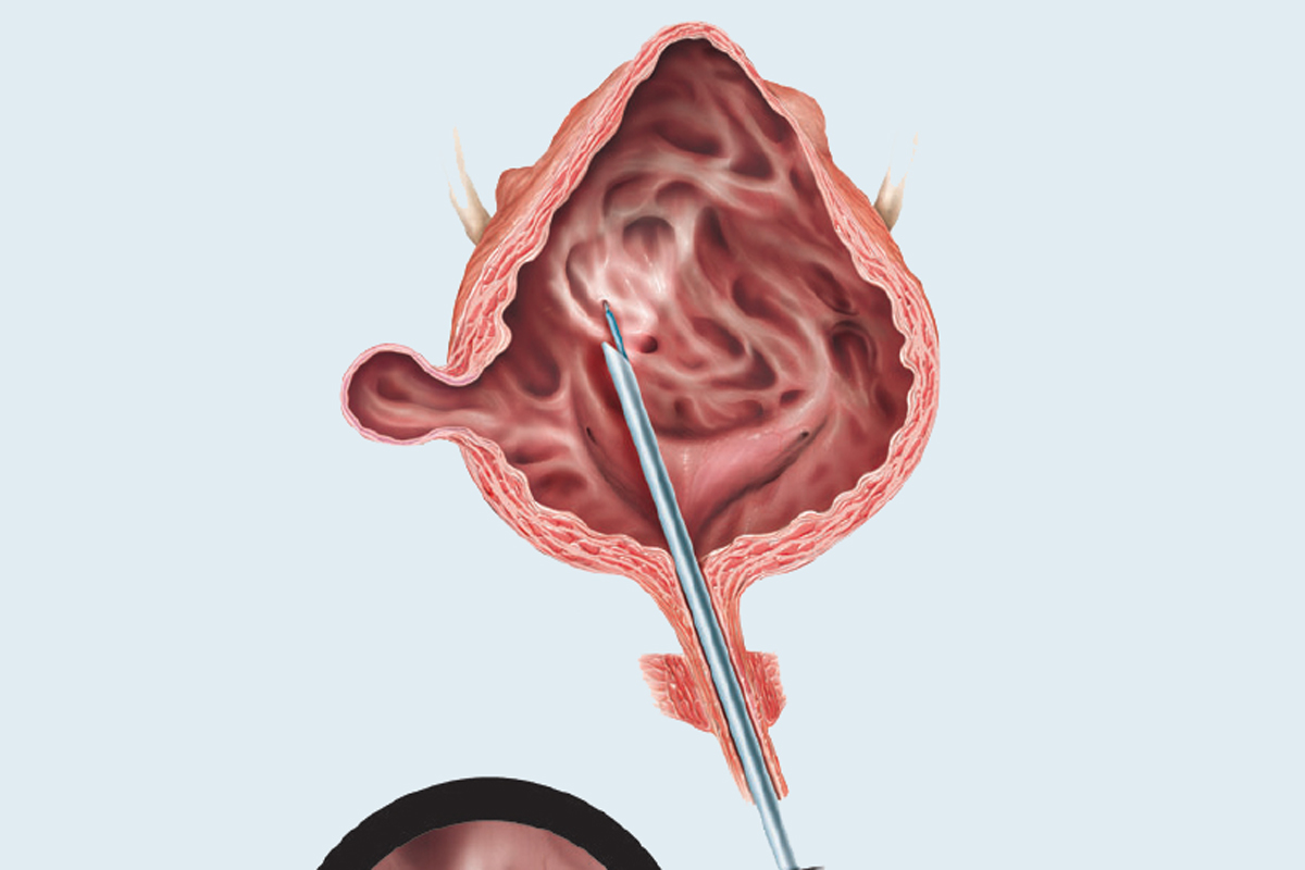 Neuro-Urology Neuro-Urology