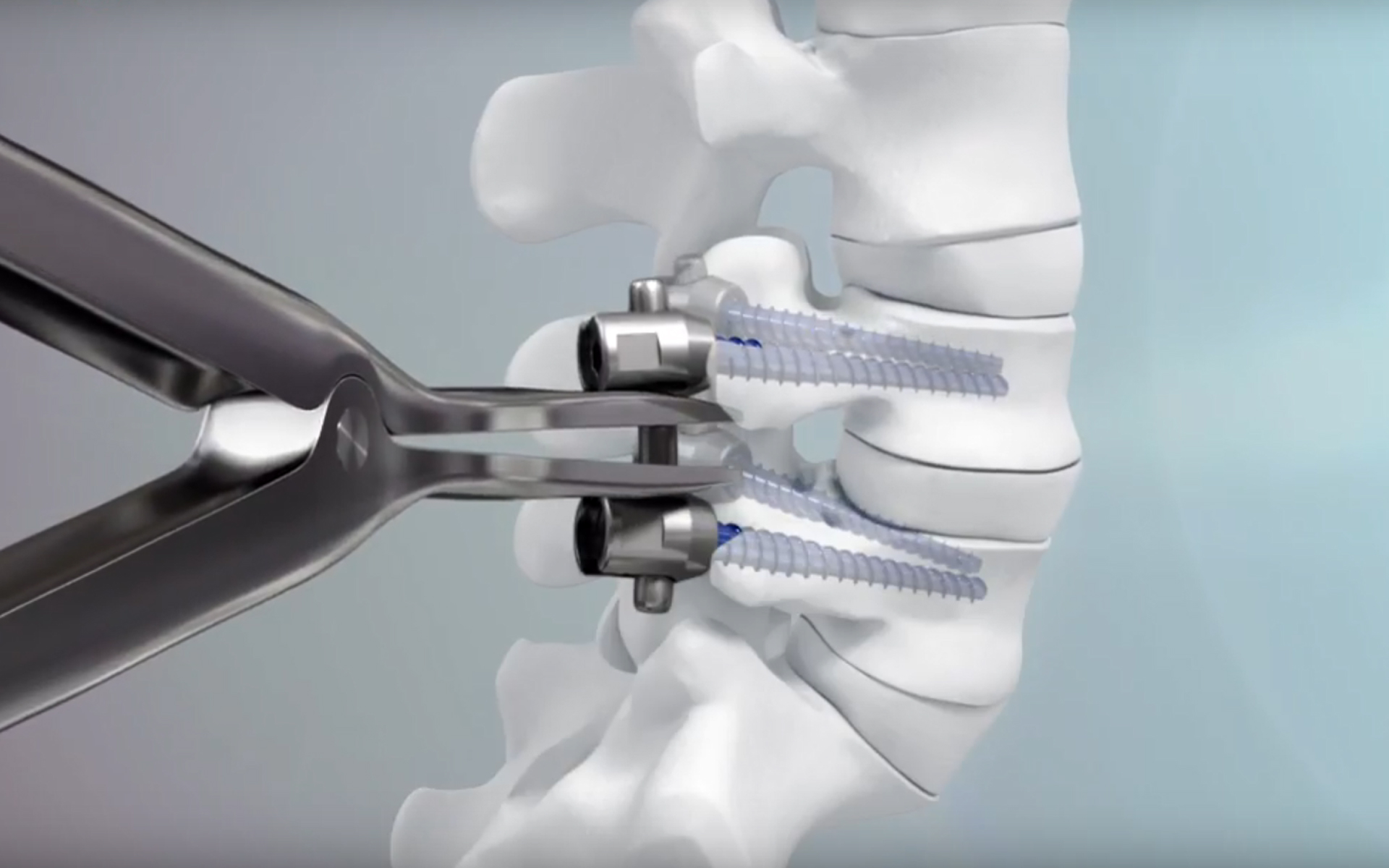 Maximale Expertise in der Wirbelsäulenchirurgie Maximale Expertise in der Wirbelsäulenchirurgie