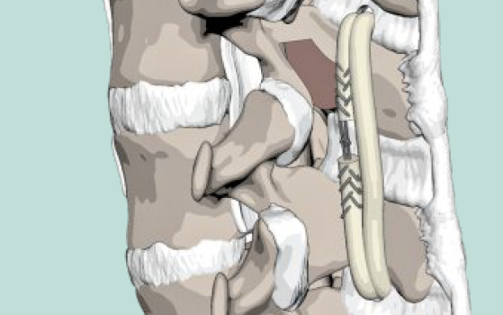 Abbildung der Methode Vertebropexie