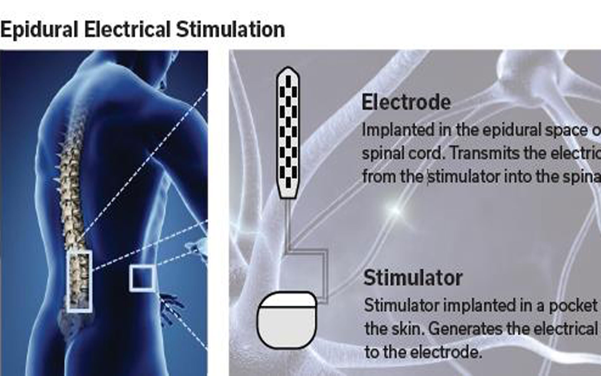 STIMO-Studie Balgrist Forschung Paraplegie