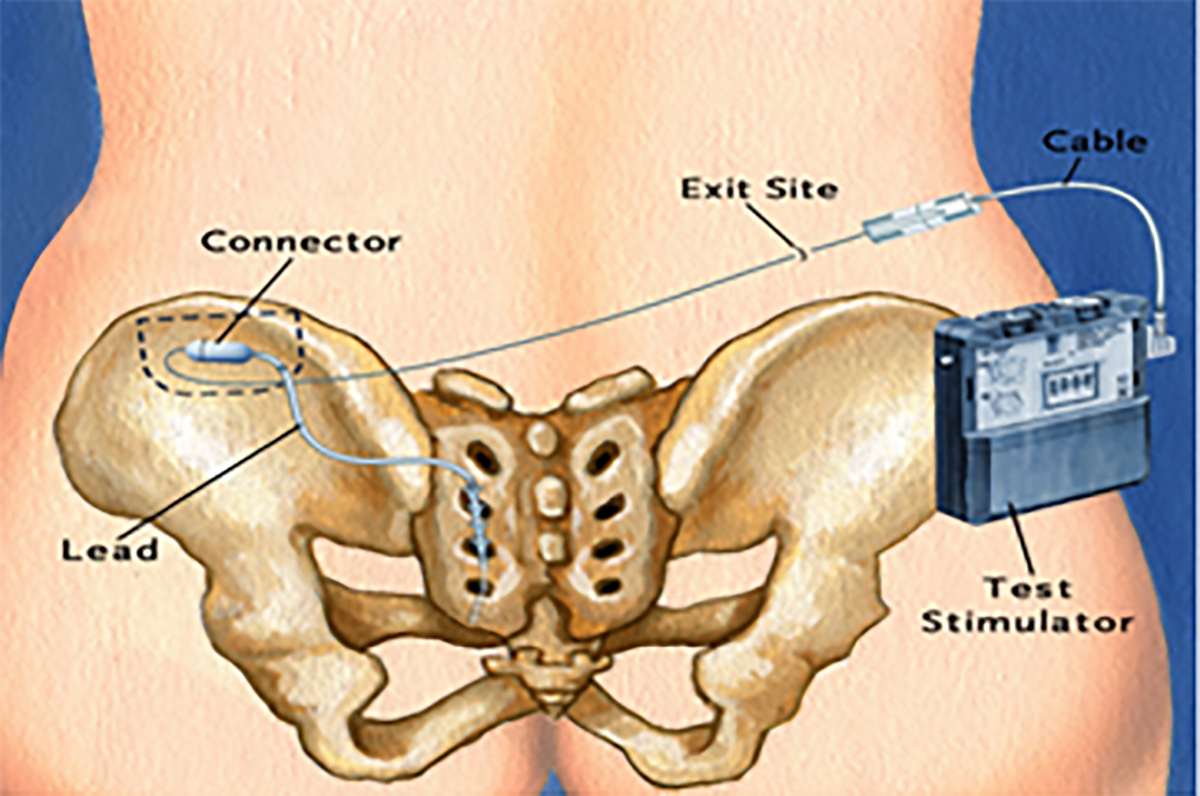 Sakrale Neuromodulation Balgrist Forschung Paraplegie