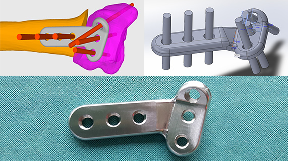 Individuelle Implantate für Patienten Individuelle Implantate für Patienten